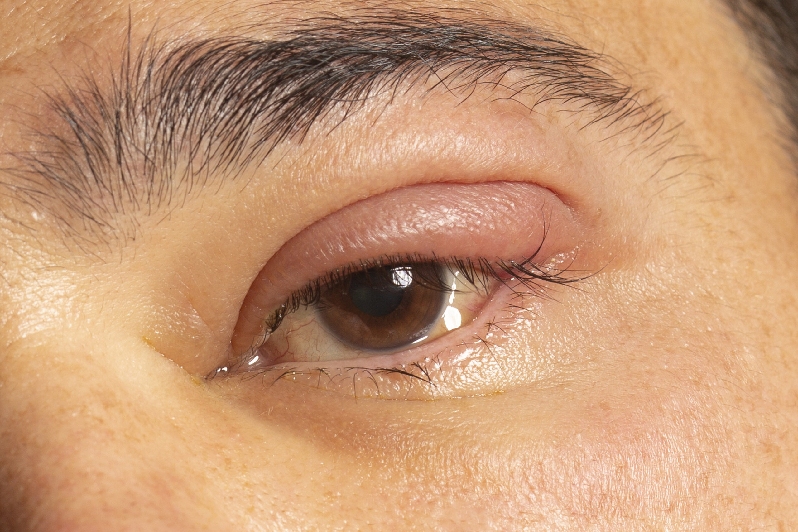 stye